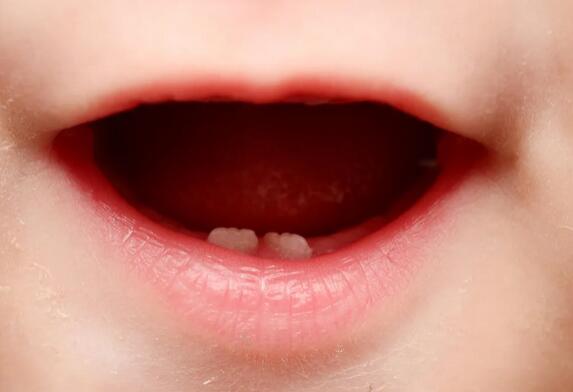 宝宝乳牙龋齿怎么办？