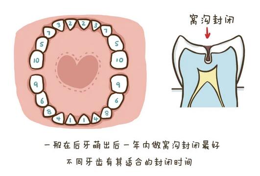 儿童牙齿窝沟封闭有必要做吗
