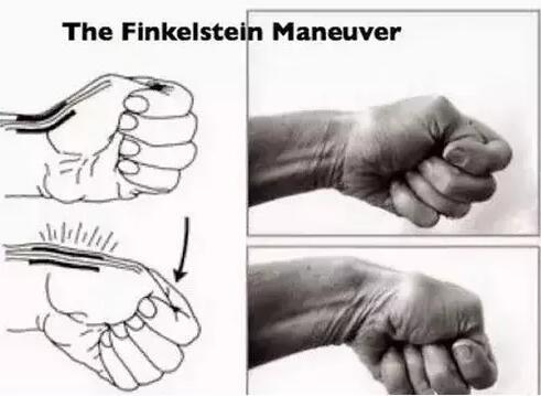 产后手腕疼、手指关节疼怎么办？可能得了妈妈手