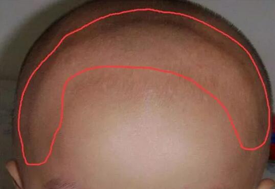 小儿囟门能不能碰，囟门早闭、晚闭有啥说法？