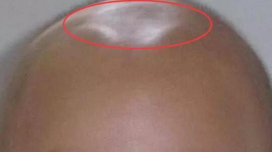 小儿囟门能不能碰，囟门早闭、晚闭有啥说法？