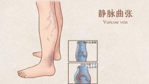 孕期为什么会静脉曲张？会血栓吗？如何预防？