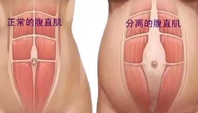 腹直肌分离怎么恢复