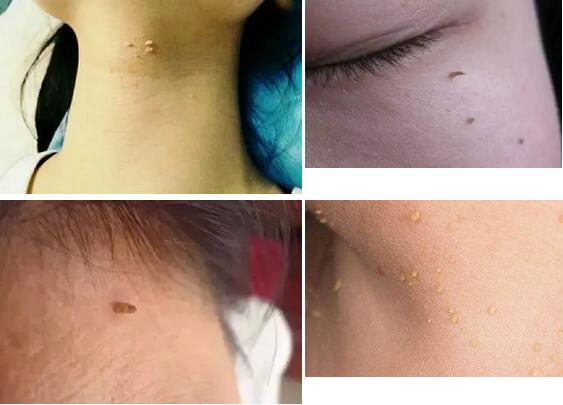 丝状疣是什么？怎么治疗比较好？