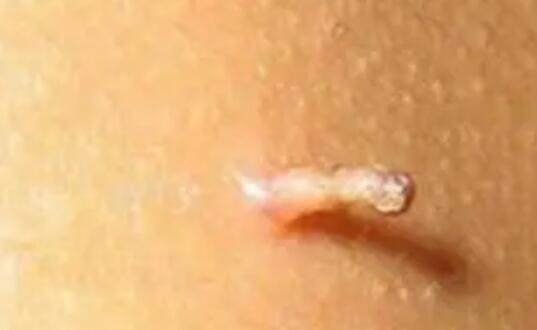 丝状疣是什么？怎么治疗比较好？