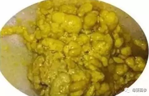 宝宝拉屎有奶瓣哪些需要警惕