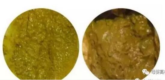 宝宝拉屎有奶瓣哪些需要警惕