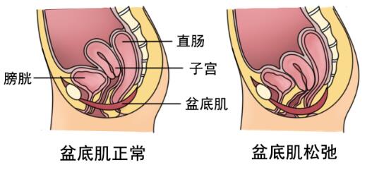 骨盆修复、盆底康复到底要不要做？