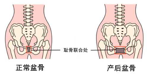 骨盆修复、盆底康复到底要不要做？