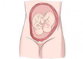 怀了双胞胎，准妈妈只能做剖宫产吗？