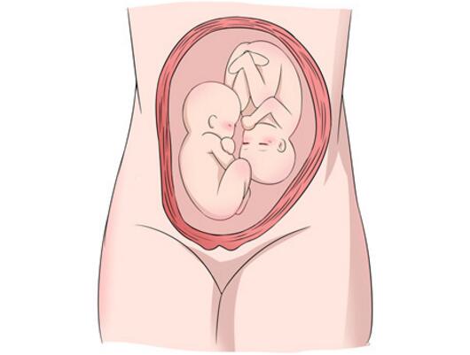 怀了双胞胎，准妈妈只能做剖宫产吗？