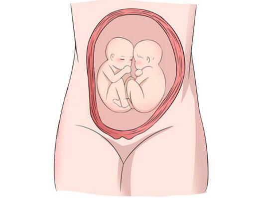 怀了双胞胎，准妈妈只能做剖宫产吗？