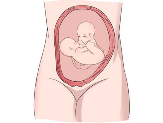 怀了双胞胎，准妈妈只能做剖宫产吗？