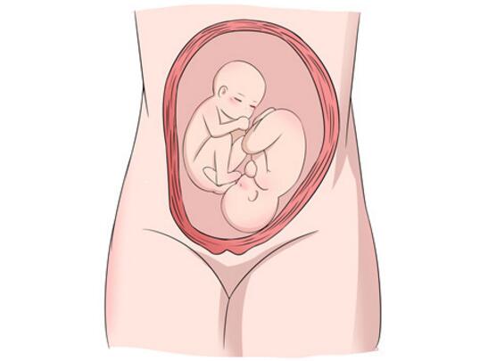 怀了双胞胎，准妈妈只能做剖宫产吗？