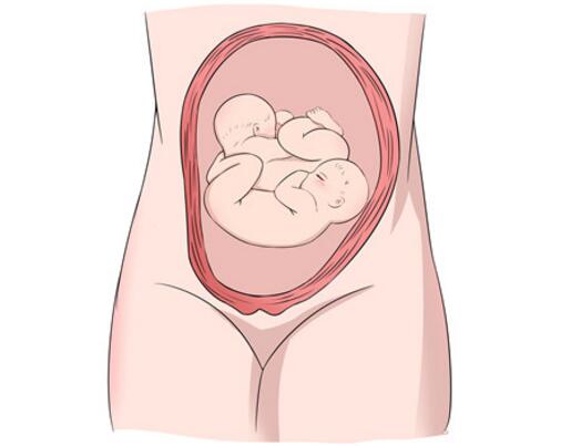 怀了双胞胎，准妈妈只能做剖宫产吗？