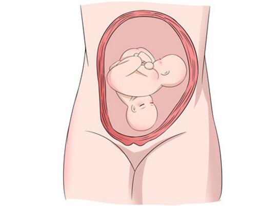 怀了双胞胎，准妈妈只能做剖宫产吗？