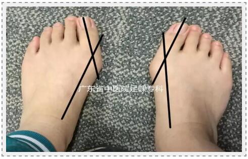 扁平足怎么判断 扁平足的危害