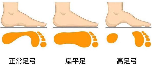 扁平足怎么判断 扁平足的危害
