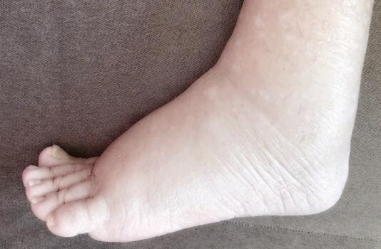 孕妇水肿是怎么回事 水肿怎么办