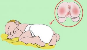 宝宝红屁屁能不能用红霉素软膏？