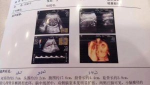 四维彩超怎么看男女？看这7个数据