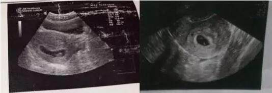 孕囊形状看性别准不准