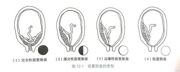 关于前置胎盘，你需要了解的事儿