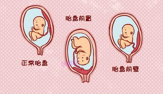 关于前置胎盘，你需要了解的事儿