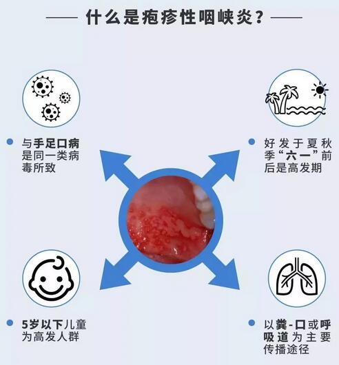 如何防治疱疹性咽峡炎