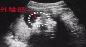 四维彩超怎么看男女怎么看