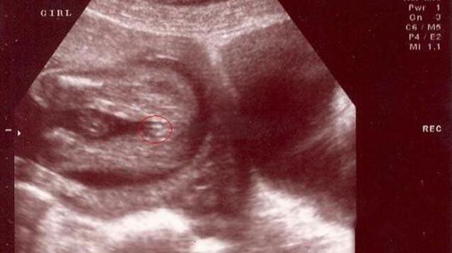 四维彩超怎么看男女怎么看