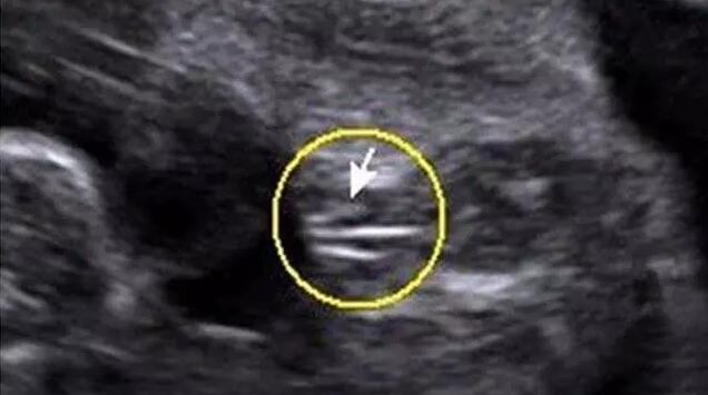 四维彩超怎么看男女怎么看