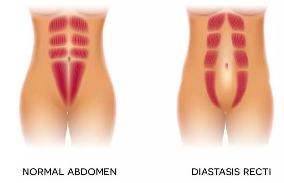 腹直肌分离是怎么回事？该怎么恢复？