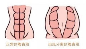 腹直肌分离是怎么回事？该怎么恢复？