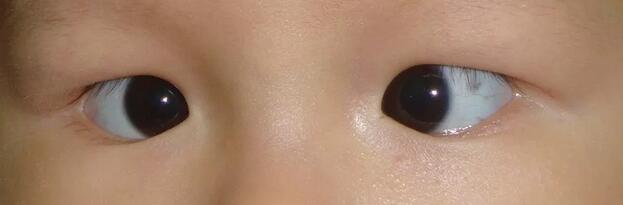 宝宝好像有「斗鸡眼」怎么办？