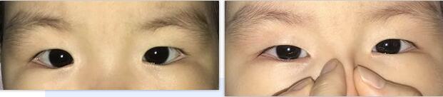 宝宝好像有「斗鸡眼」怎么办？