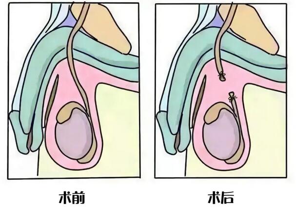 男性结扎后影响啪啪啪吗？精子都去哪了？