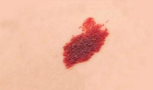 胎记是好东西嘛 做一个简单的归类