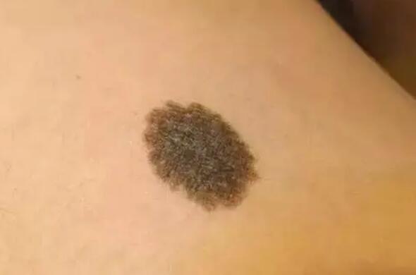 胎记是好东西嘛 做一个简单的归类