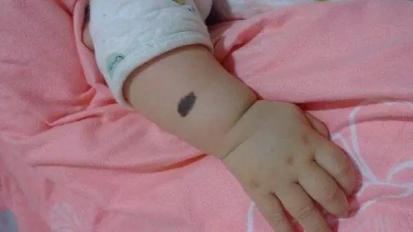 胎记是怎样来的 五种胎记要注意