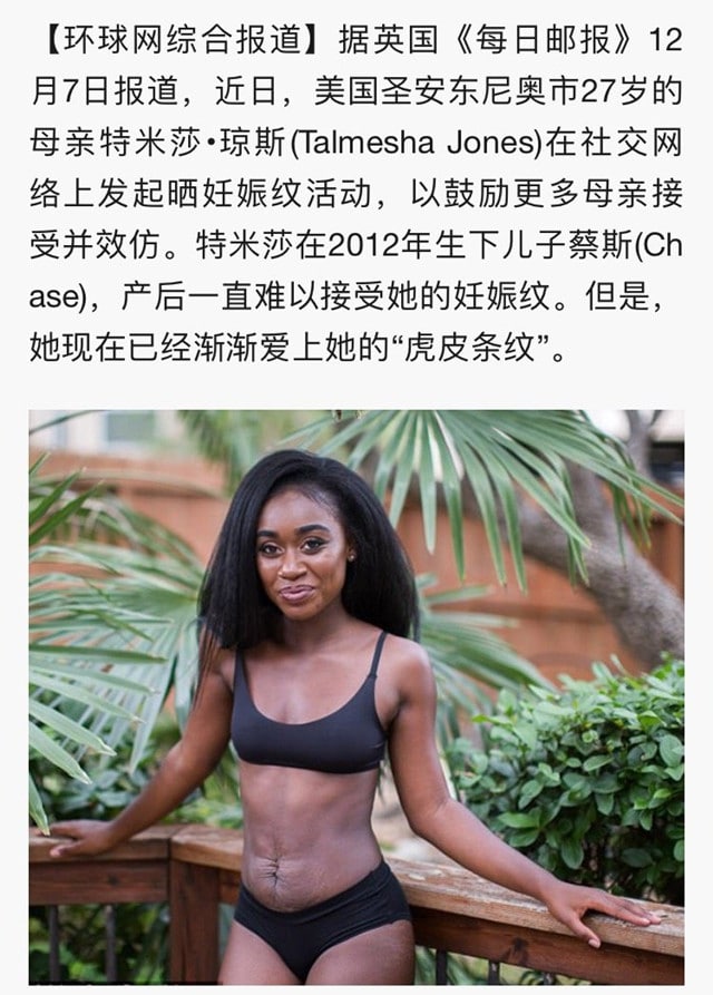 哪些孕妇容易有妊娠纹 怎么消除