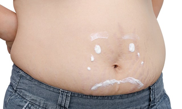 哪些孕妇容易有妊娠纹 怎么消除