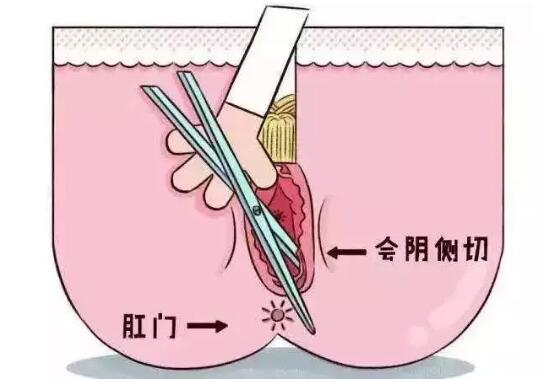 顺产会阴侧切术影响产后性生活吗？