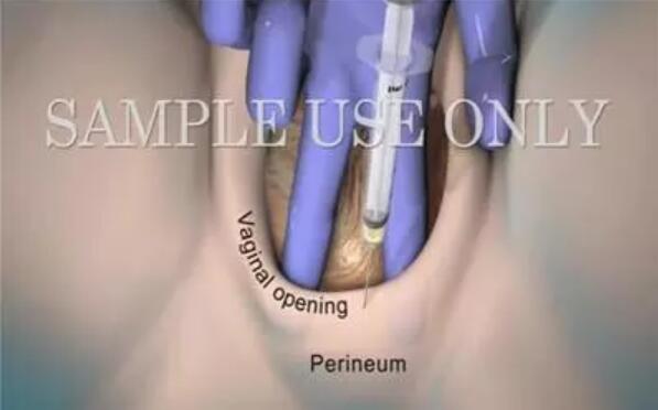 顺产会阴侧切术影响产后性生活吗？