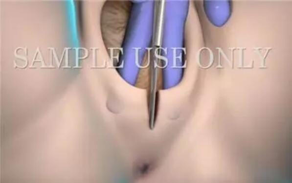 顺产会阴侧切术影响产后性生活吗？