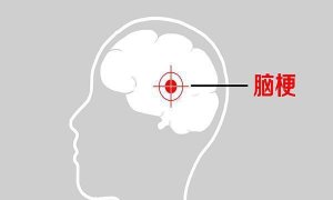 脑梗塞的前兆症状有哪些