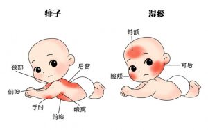 痱子和湿疹的区别 痱子和湿疹怎么治疗