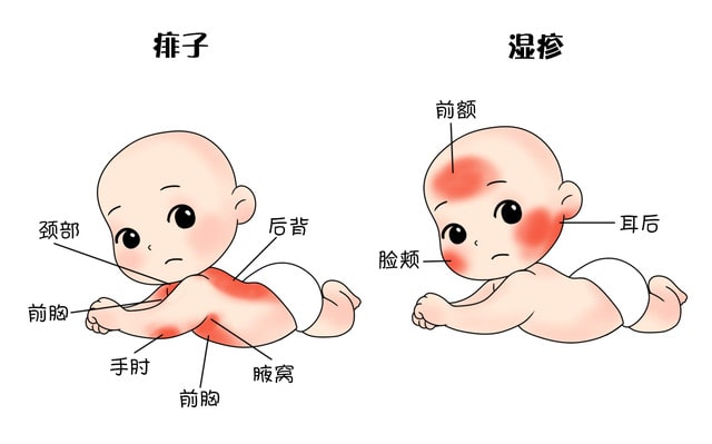 痱子和湿疹的区别 痱子和湿疹怎么治疗