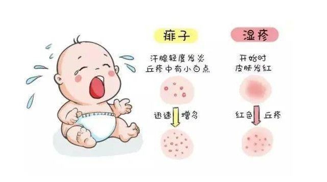 痱子和湿疹的区别 痱子和湿疹怎么治疗