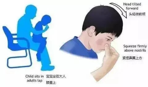 小孩流鼻血怎么处理